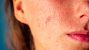 Sai come distinguere l’herpes dall’acne?