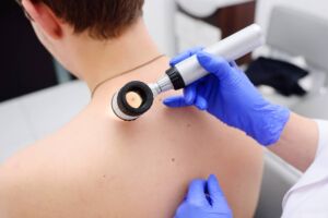 Melanoma cutaneo: quali sono i 6 campanelli d’allarme?