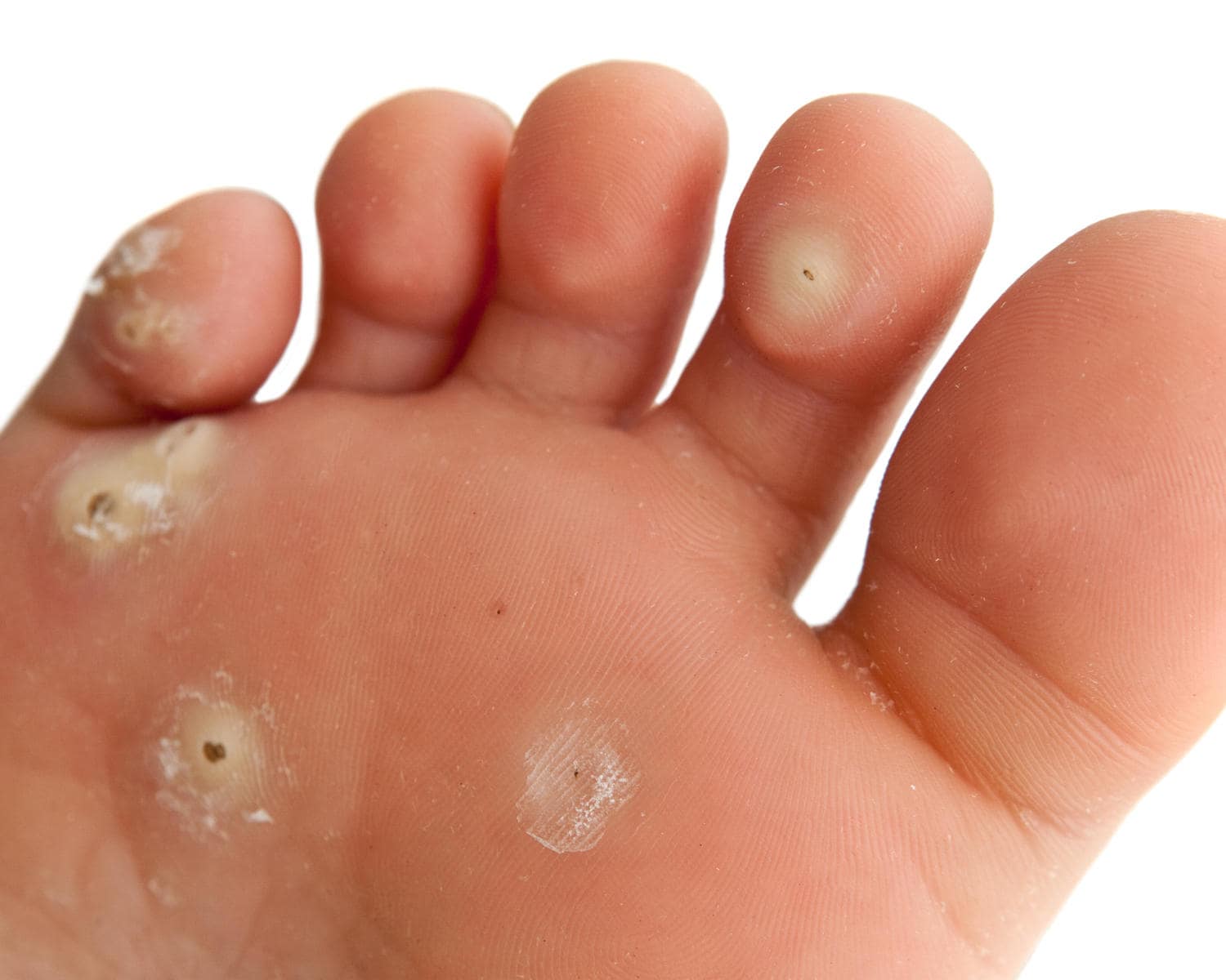 come eliminare il papilloma virus verruche