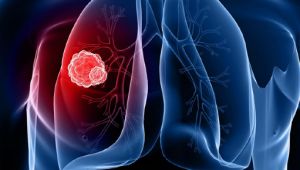 Cancro ai polmoni, quale dieta seguire durante il trattamento
