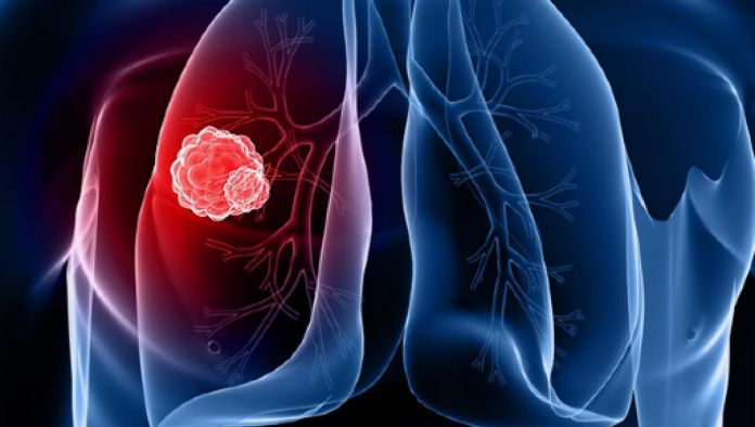 cancro ai polmoni sintomi comuni