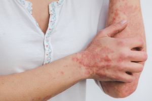 Psoriasi, quali sono i cibi da evitare?