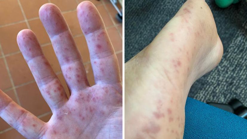 Afta epizootica in Australia, eruzioni cutanee dolorose sul corpo (FOTO)