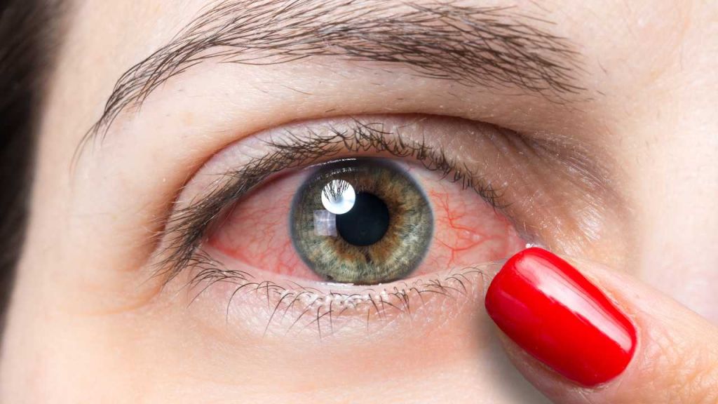 La sindrome dell’occhio secco, quali sono i sintomi? Come si cura?