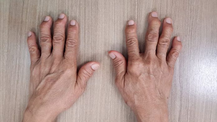 artrite psoriasica psoriasi