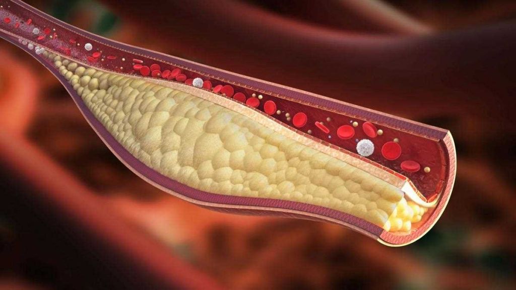 7 rimedi naturali per contrastare il colesterolo alto