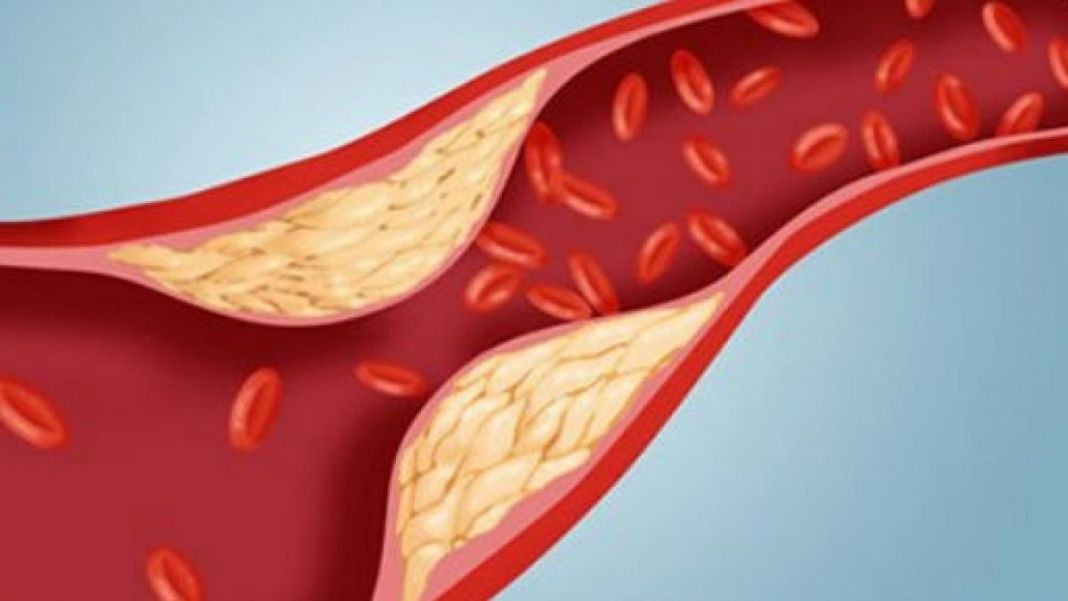 Dislipidemia, cos'è, cause e trattamento