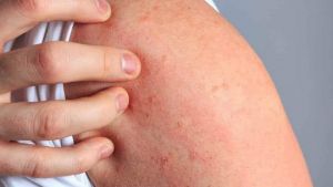 5 rimedi naturali per combattere l’eczema