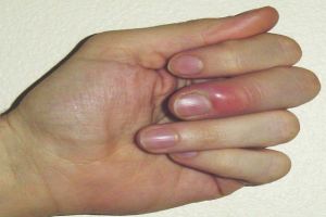 Cosa fare in caso di dito schiacciato? I rimedi