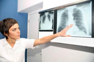 Embolia polmonare: quali sono i segnali d’allarme?