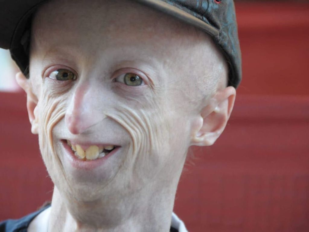 Terza dose per Sammy Basso, “fidatevi della scienza”, l’appello del 25enne con la progeria