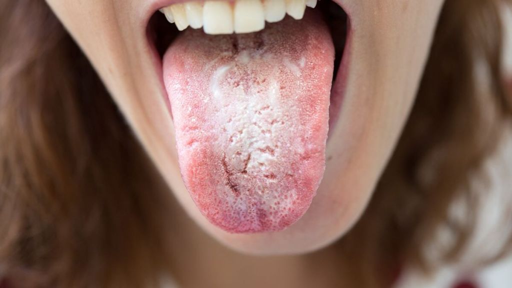 Non ignorare i segnali: il cancro alla lingua può essere sconfitto
