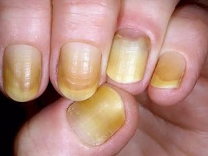 Perché le unghia diventano gialle? Le cause più comuni