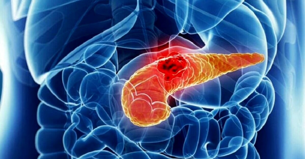 Tumore al pancreas: i sintomi da non sottovalutare