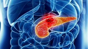 Fedez e il cancro al pancreas, quali sono i campanelli d’allarme?
