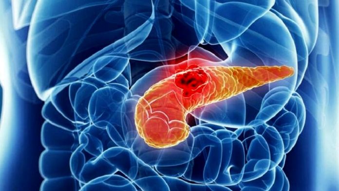 cancro pancreas sintomi