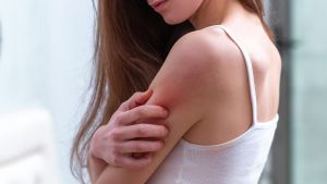 Dermatite atopica: cos’è e come affrontarla