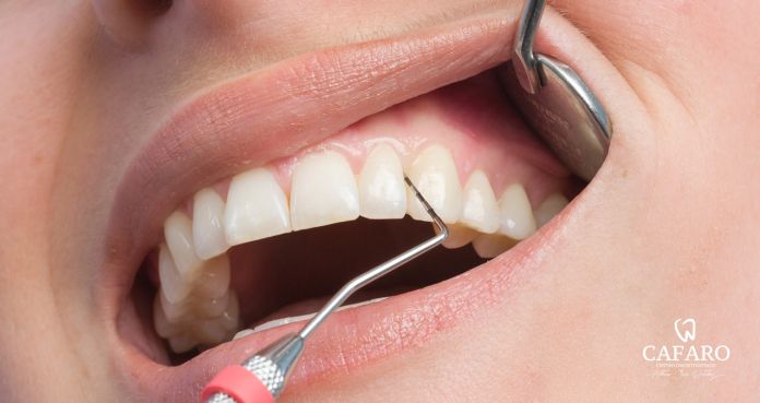 beautiful smile made by veneers