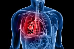 Cancro ai polmoni, perché la maggioranza dei fumatori non sviluppa il tumore?
