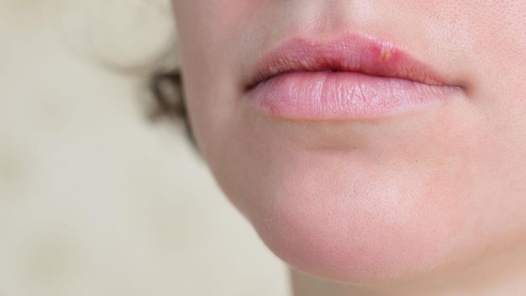 Herpes labiale, quali sono i farmaci e i rimedi casalinghi?