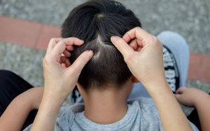 Brufoli blu fluorescenti sulla testa di un bambino, cosa gli è successo?