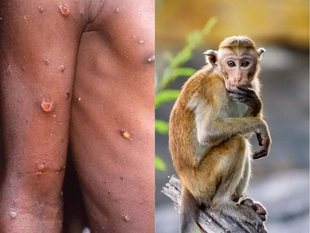 Vaiolo delle scimmie.