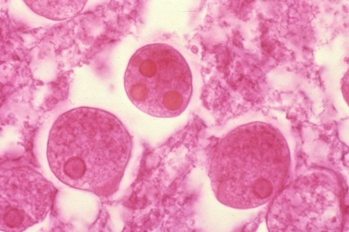 amebiasi
