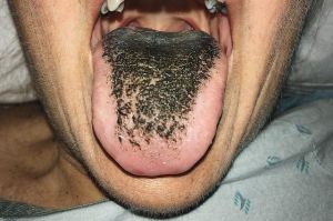 Caso bizzarro, peli neri coprono la lingua di un giovane uomo
