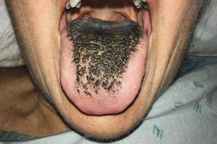 sindrome lingua nera Sindrome della lingua nera villosa.