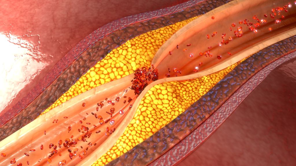 Colesterolo, quali sono gli alimenti da evitare?