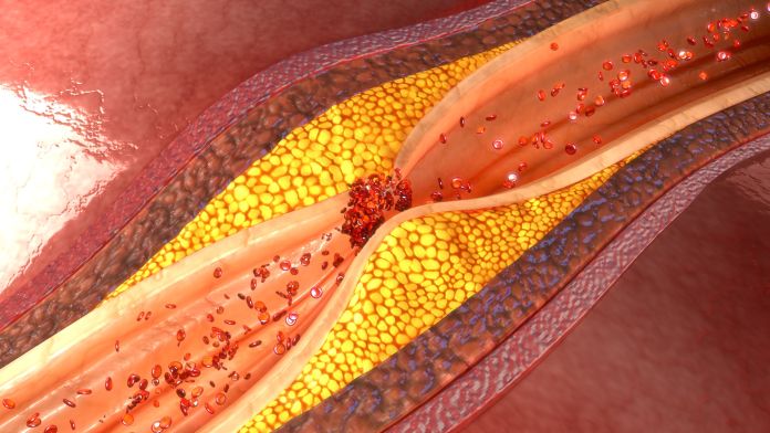 colesterolo Colesterolo, quali sono gli alimenti da evitare?