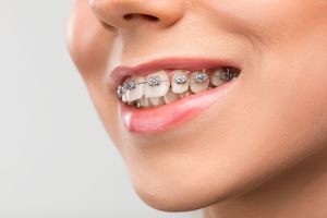 Malocclusione dentale: cos’è e come trattarla