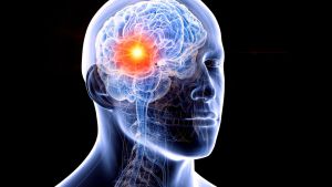 Cancro al cervello, le origini, i sintomi e come si interviene