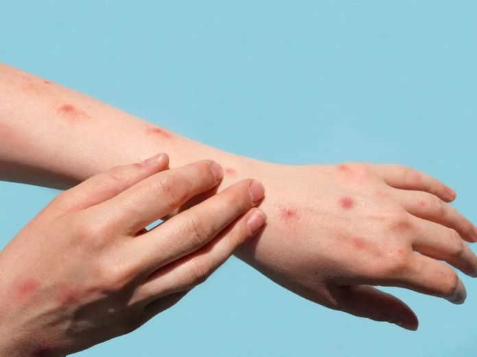 vaiolo scimmie contagio Vaiolo delle scimmie.