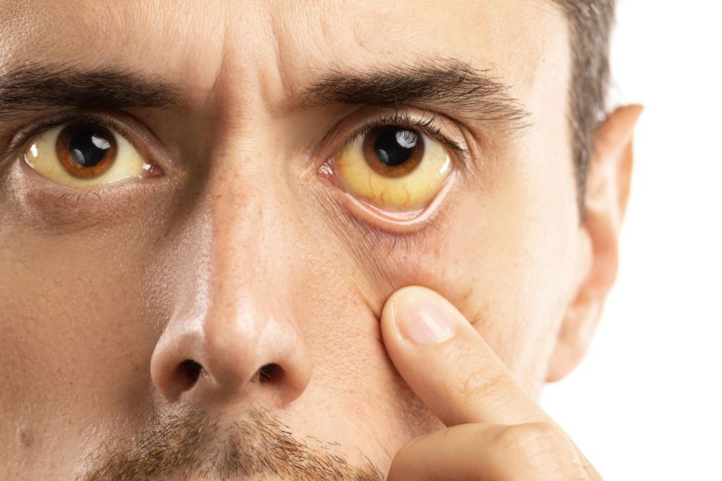 Giallo nel bianco degli occhi? Cos’è l’ittero: cause e come si manifesta