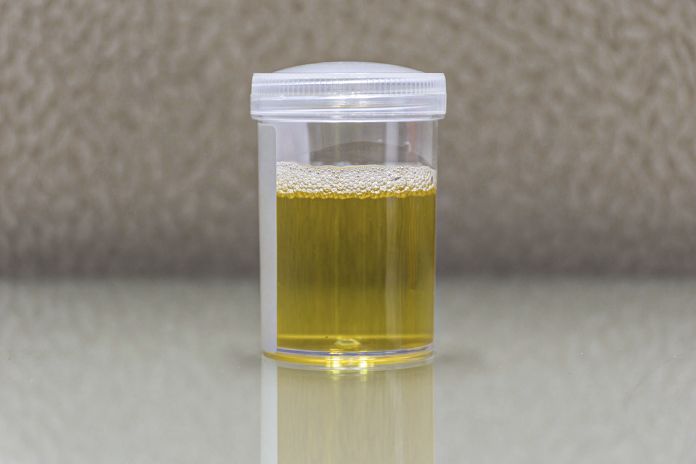 Schiuma nelle urine.