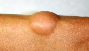 Lipoma: quali sono le cause e quando preoccuparsi