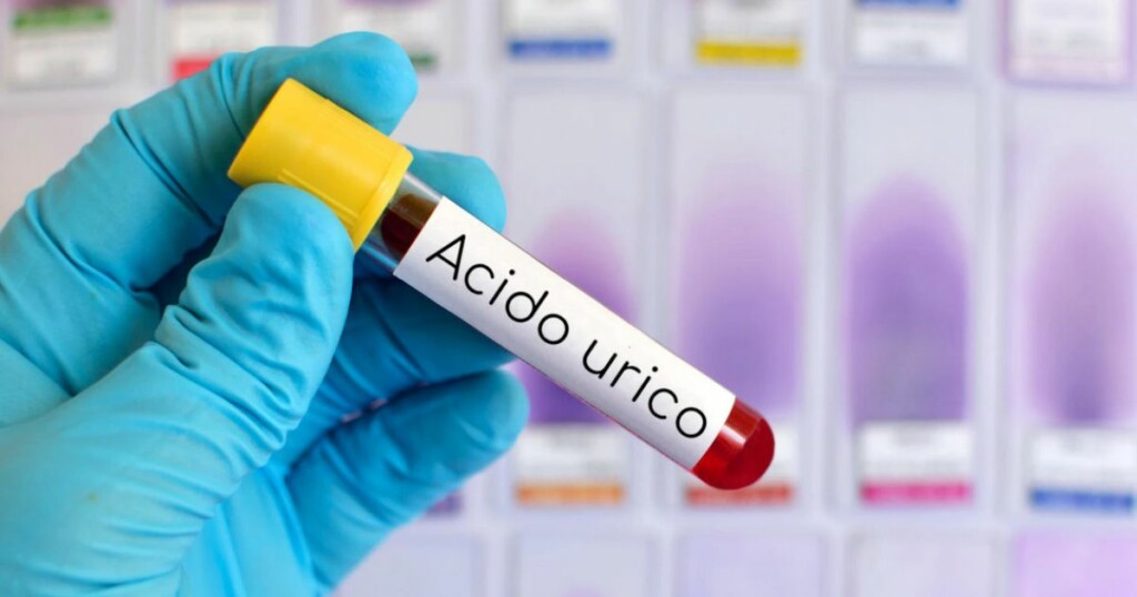 Acido urico: cosa succede se è alto o basso?