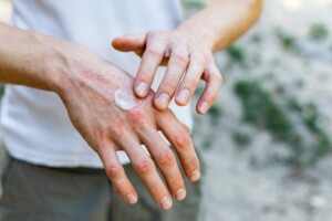 Mani che soffrono il freddo: crema da preparare in casa