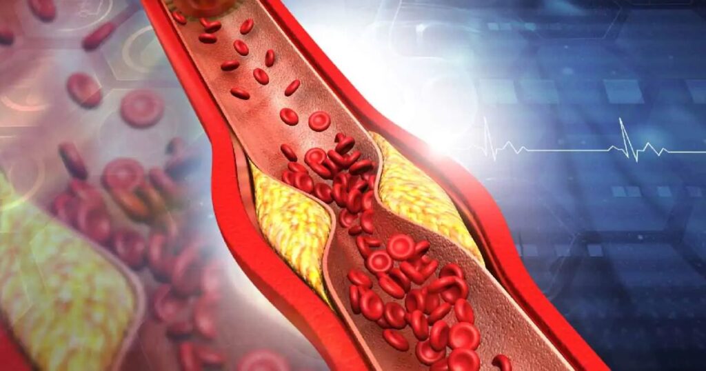 Arterie ostruite.