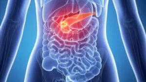 Cancro al pancreas: i campanelli d'allarme.