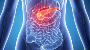 Cancro al pancreas, 4 campanelli d’allarme da conoscere