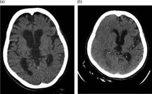 Edema cerebrale: cos’è e quali sono le cause