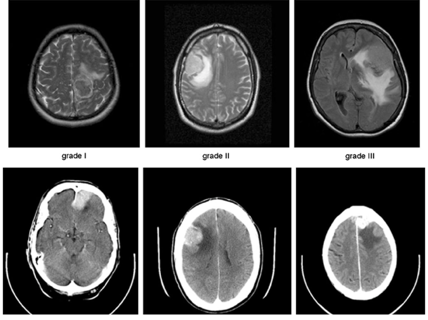 edema cerebrale