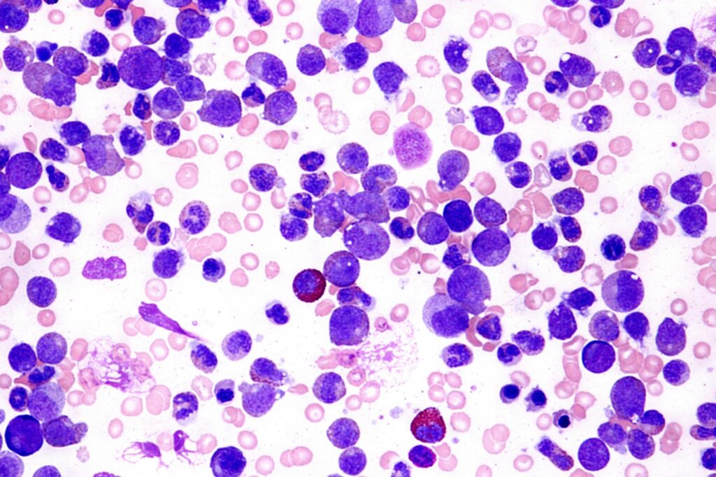 leucemia mieloide acuta