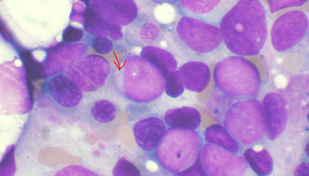 leucemia mieloide acuta