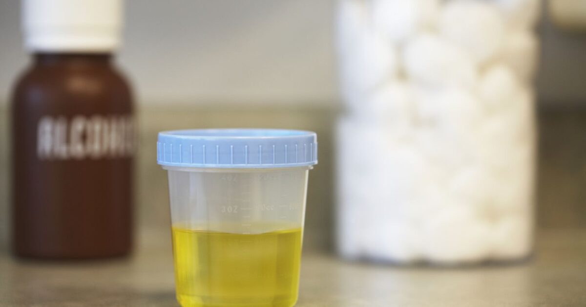Nelle Urine Si Vede Se Fumi Pus nelle urine: cause e sintomi della piuria
