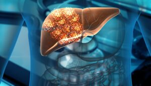 Cancro al fegato: ci sono 2 modi per predire la malattia