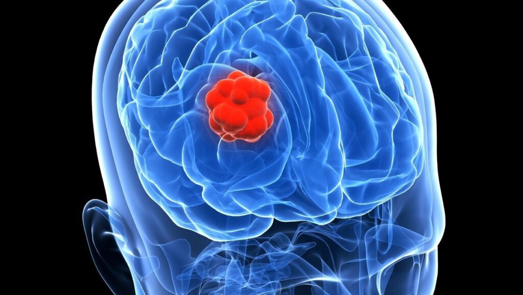Tumore al cervello: i sintomi.