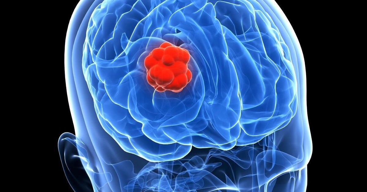Tumore al cervello: quali sono i sintomi?